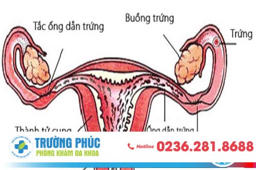 Hình ảnh tắc ống dẫn trứng ở nữ giới