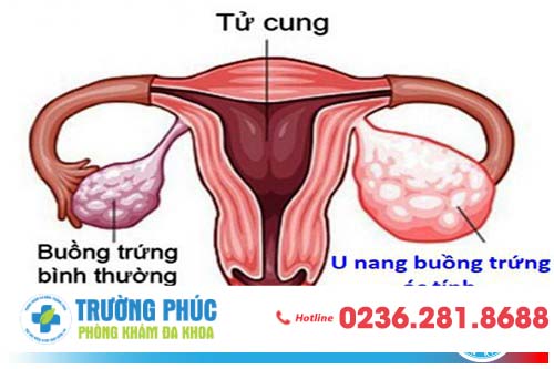 Hình ảnh u nang buồng trứng ác tính