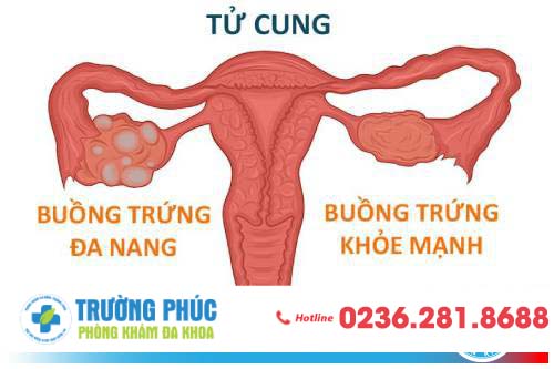 Những dấu hiệu thường gặp của bệnh đa nang buồng trứng