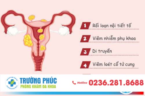 U xơ tử cung là gì? U xơ tử cung là gì?
