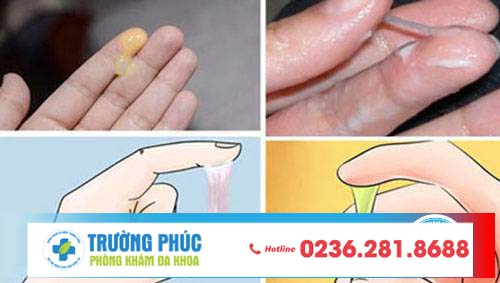 Những bệnh âm đạo mà chị em dễ mắc phải