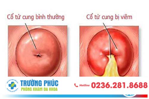 Hình ảnh cổ tử bình thường và cổ tử cung bị viêm