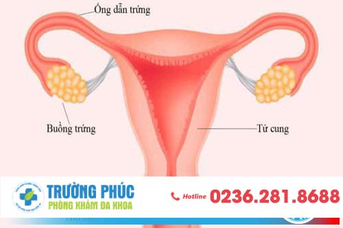 Tắc ống dẫn trứng nguyên nhân gây vô sinh ở nữ giới Tắc ống dẫn trứng nguyên nhân gây vô sinh ở nữ giới