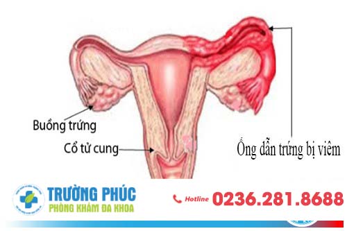 Hình ảnh ống dẫn trứng bị viêm