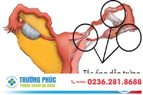 Tắc ống dẫn trứng nguy cơ gây vô sinh ở nữ giới