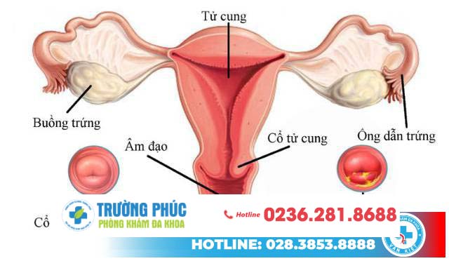 Trễ kinh dấu hiệu bất thường của sức khỏe sinh sản nữ giới
