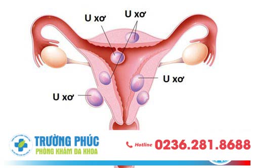 U xơ tử cung là tình trạng thường gặp ở chị em nữ giới