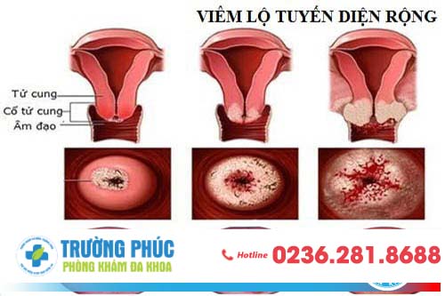 Viêm lộ tuyến cổ tử cung diện rộng